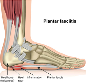 Plantar fascia ligament