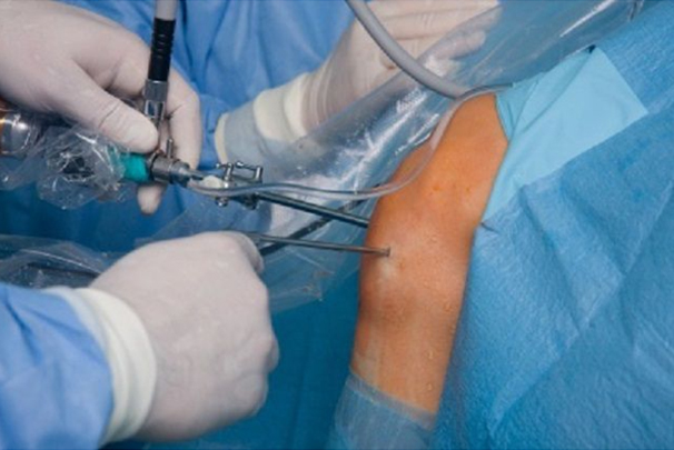 Cartilage damage in the knee and ankle Surgeon Singapore