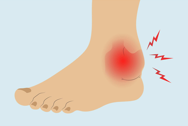 Symptoms of Ankle Arthritis
