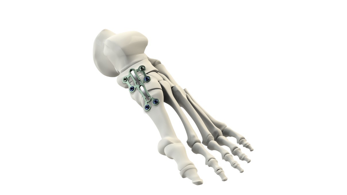 Foot Stabilization Column Implant