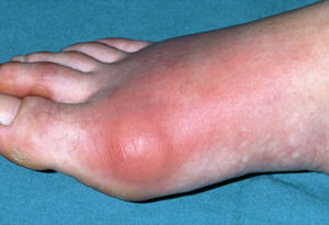 Big Toe Gout Symptoms, Causes, and Treatments