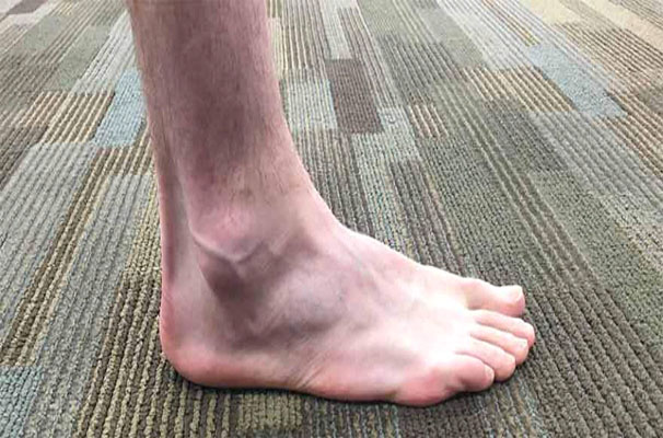 Ankle bone spurs