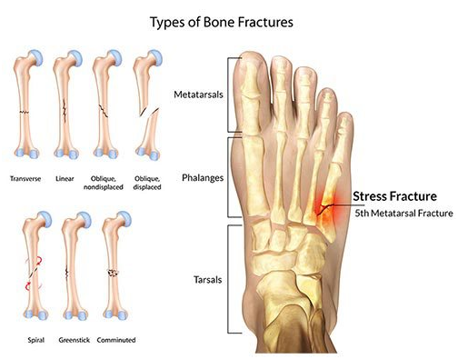 Stress Fractures of the Foot