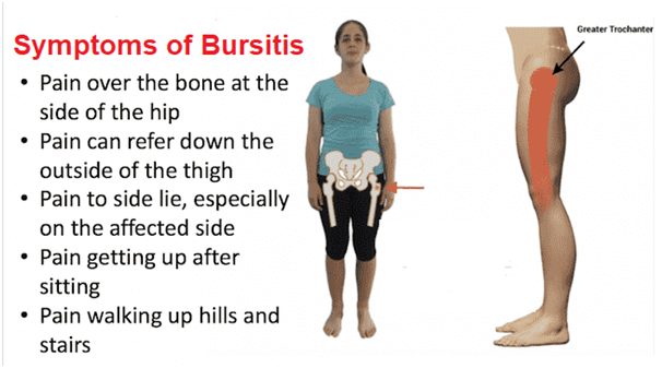 symptom-bursitis