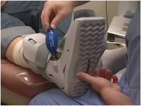 surgery ankle fracture boot walking treatment injury