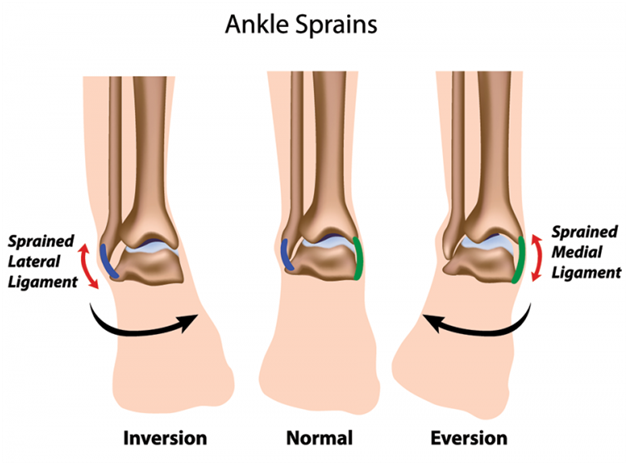 Types of Ankle Sprain