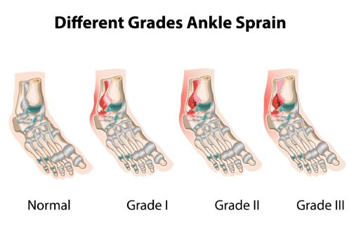 Grades of Ankle Sprain