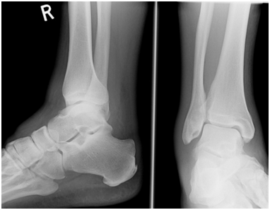 X-rays test for Ankle Sprain