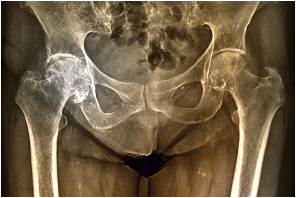 Types of Arthritis affecting hips