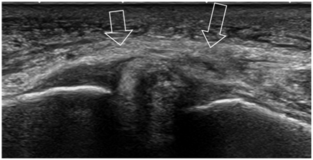 Ultrasound test for Ankle Sprain