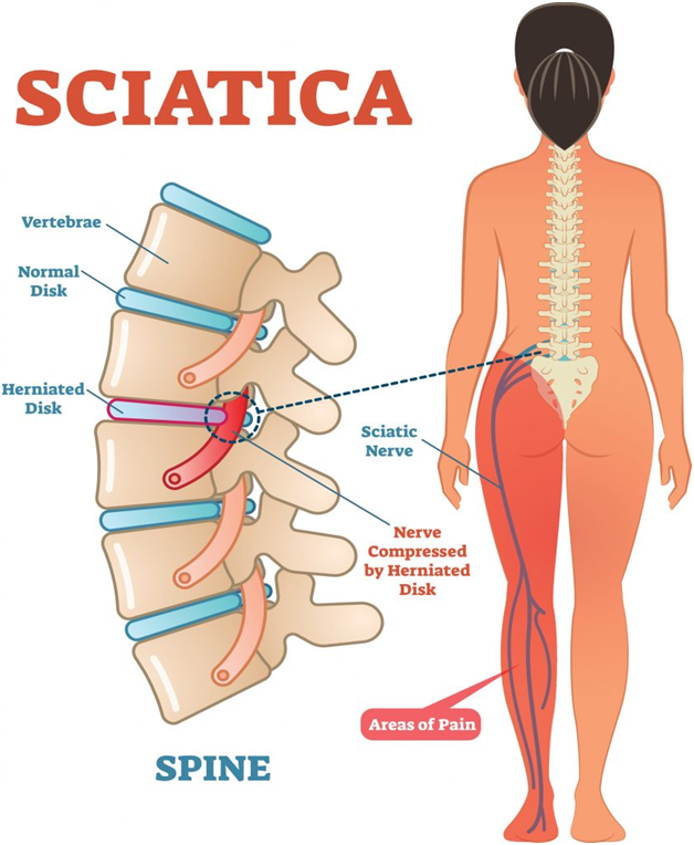 Pain with Sciatica