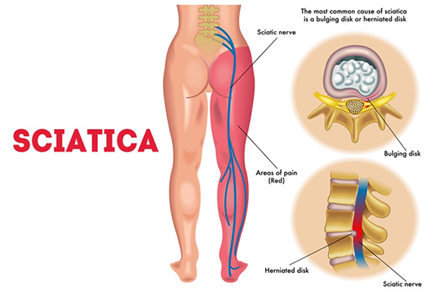 Lower back pain with Sciatica