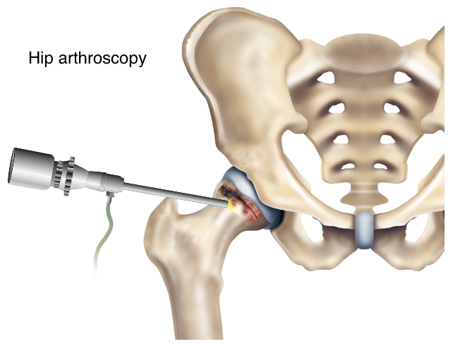 Hip arthroscopy surgery