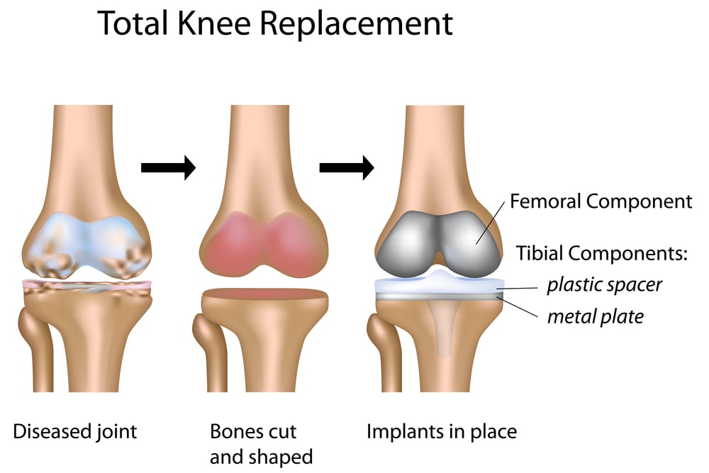 Total Knee Replacement Surgery Diagram