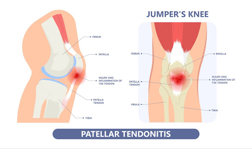 Patellar Tendonitis Inflammation (Jumper’s Knee)