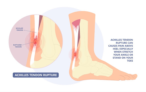achilles tendonitis treatment in singapore
