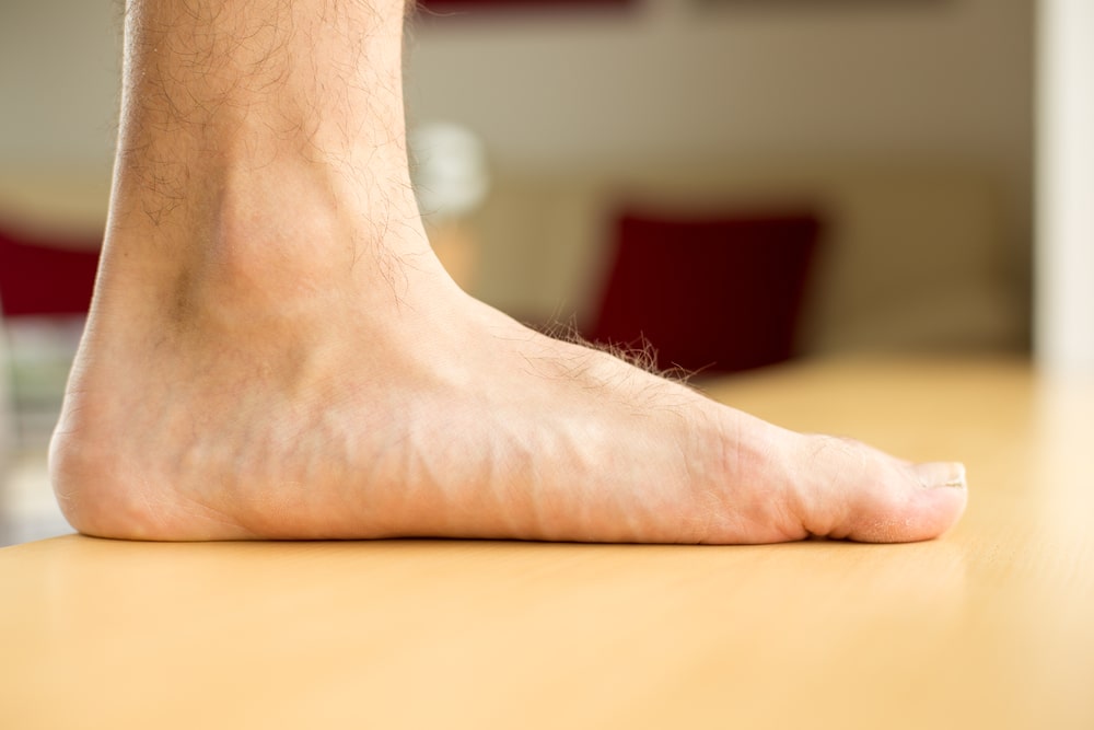 flat-feet-treatment