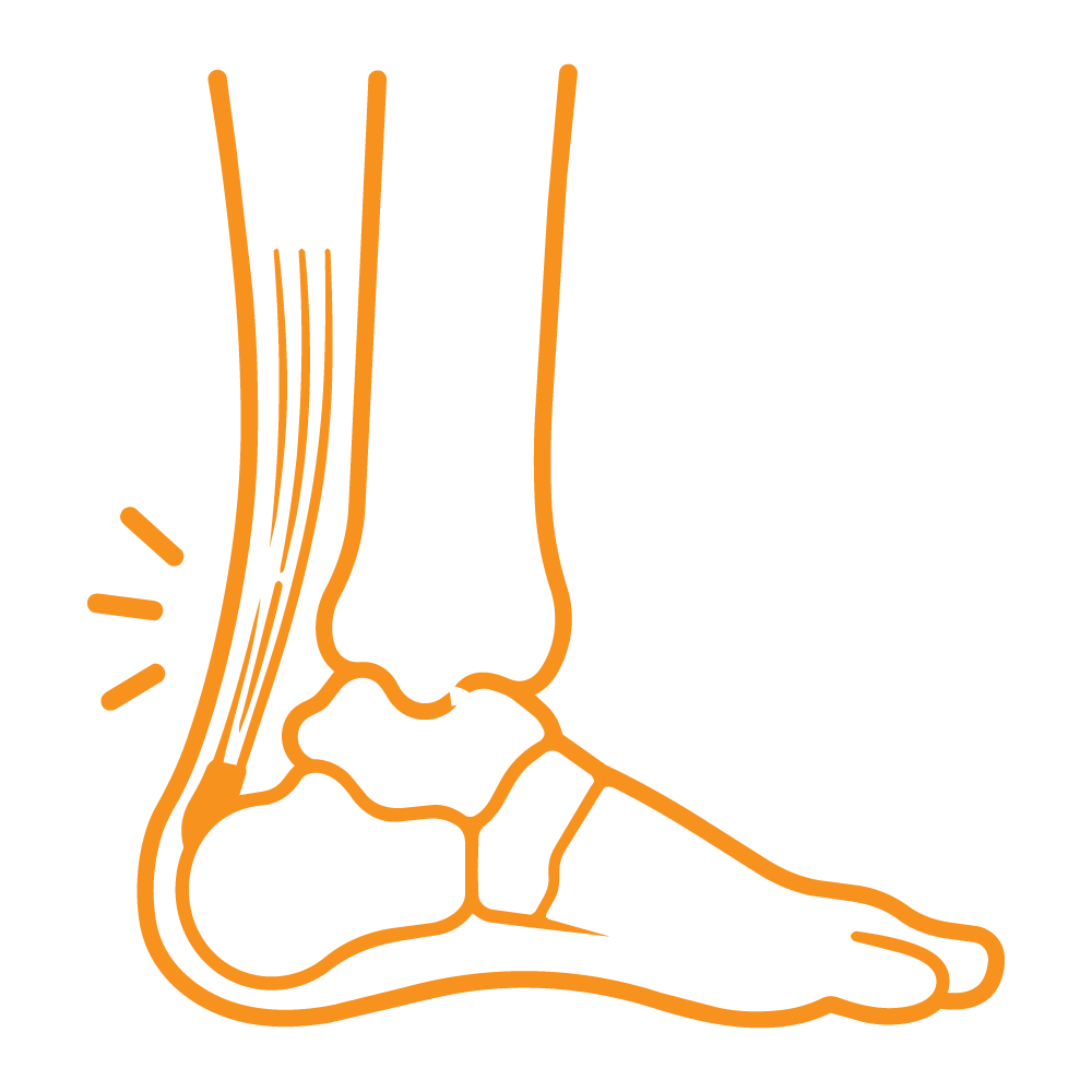 Icon Ankle ligament reconstruction surgery