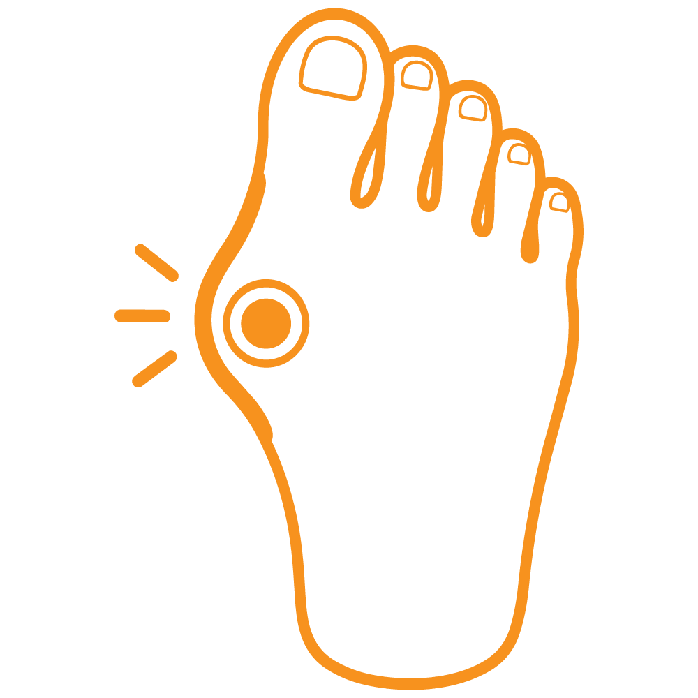 Icon Bunion Surgery