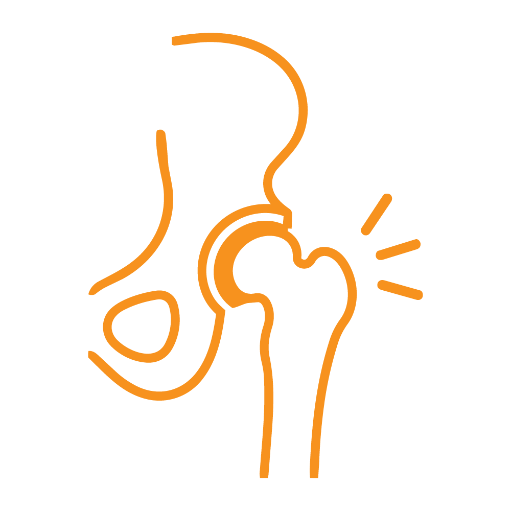 Icon Hip arthritis