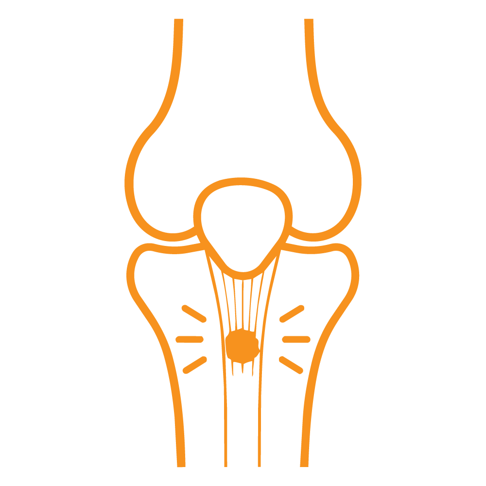 Icon Patellar tendonitis (jumper's knee)