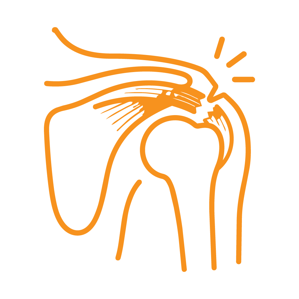 Icon Rotator cuff tear