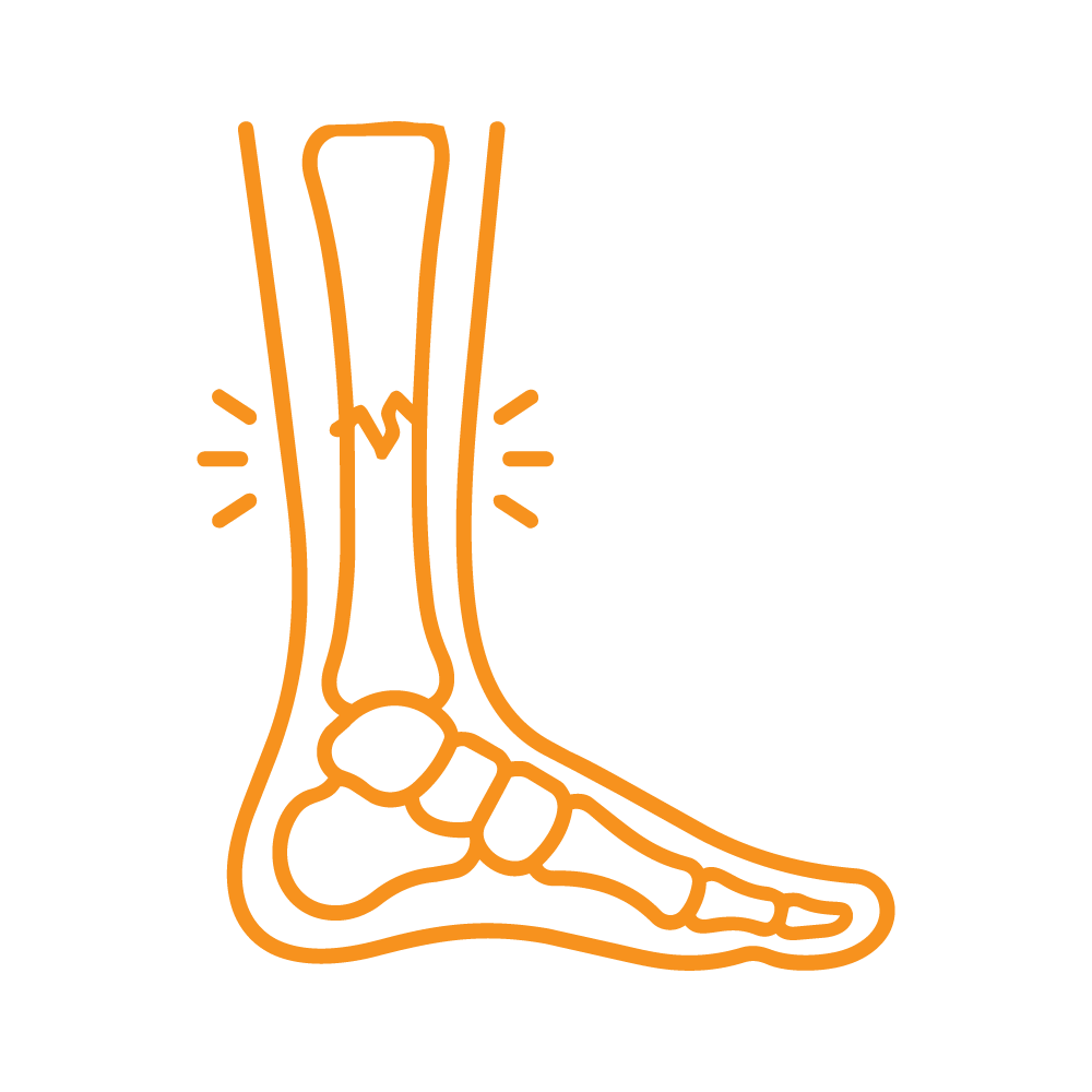Icon Stress fracture