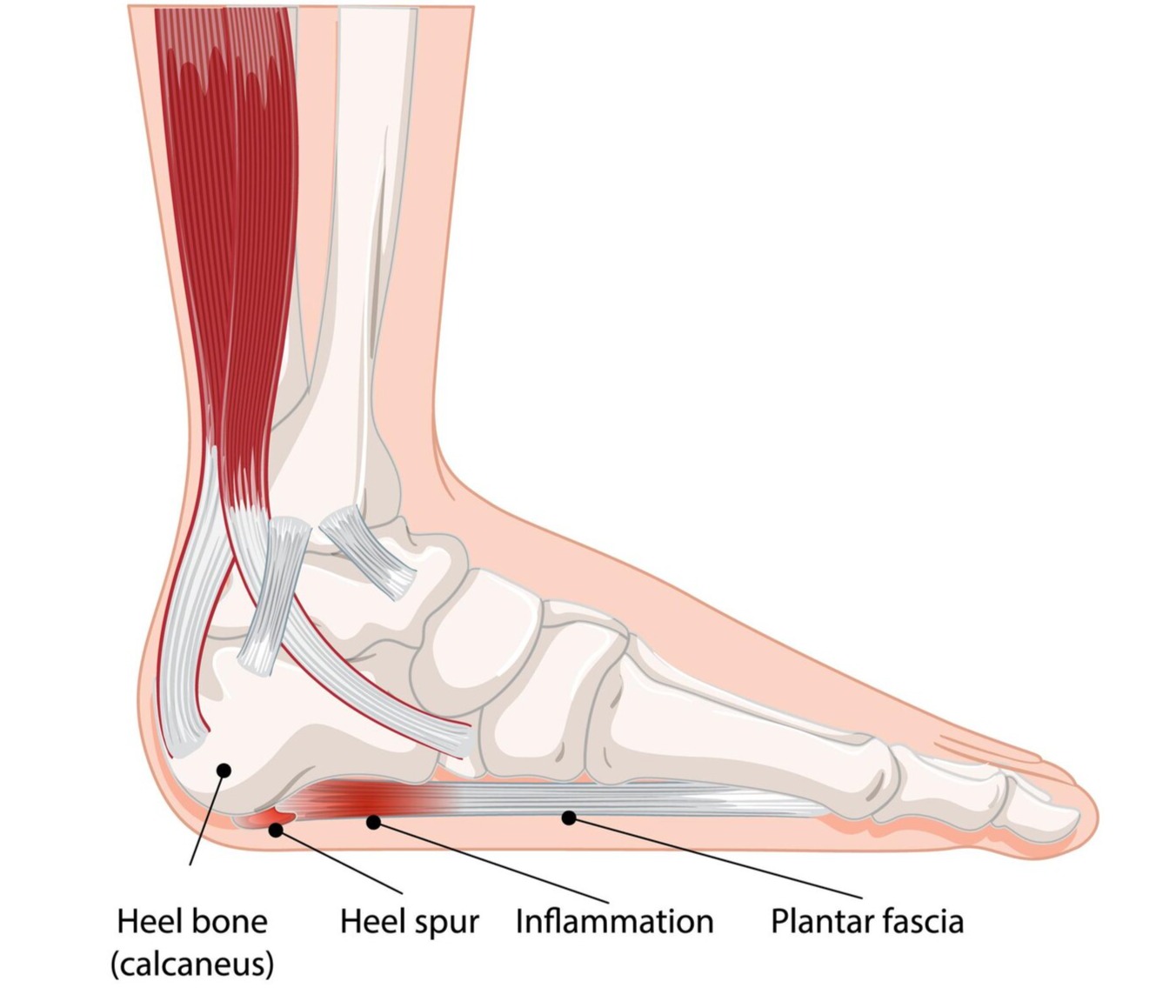 Recovery Plantar Fasciitis Recovery Plantar Fasciitis