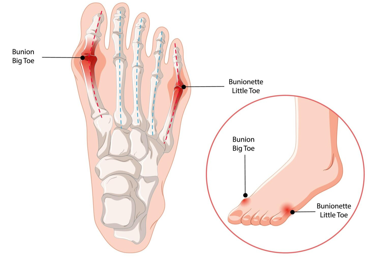 bunions symptom
