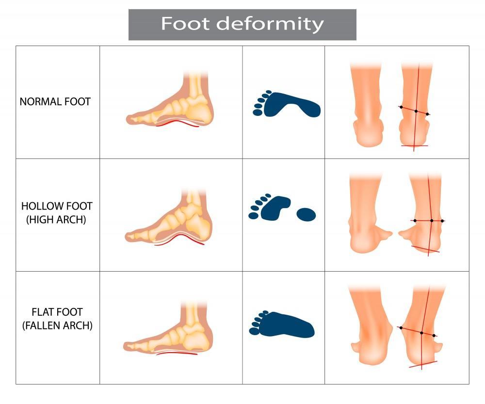 flat feet surgery recovery time flat feet surgery recovery time