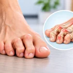 Causes Claw Toes and How Are They Treated